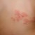 #2: localized group of herpes boils over the back. #2: localized group of herpes boils over the back.