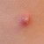 #3: Single blister of herpes zoster. #3: Single blister of herpes zoster.