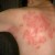#6: Groups of boils over the back of a patient. #6: Groups of boils over the back of a patient.