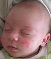 Baby acne