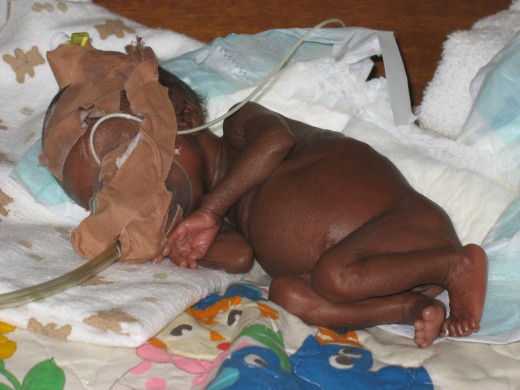 A small premature baby in with an oxygen mask improvised from a medication cup and dressing tape (plaster). ECWA Evangel Hospital, Jos, Nigeria.