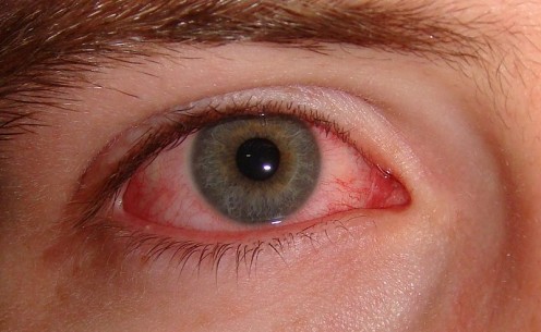 Symptoms, Causes, and Treatment for Severe Dry Eye Syndrome Symptoms, Causes, and Treatment for Severe Dry Eye Syndrome