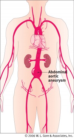 Old body - new pipes - Abdominal aortic aneurism (AAA)