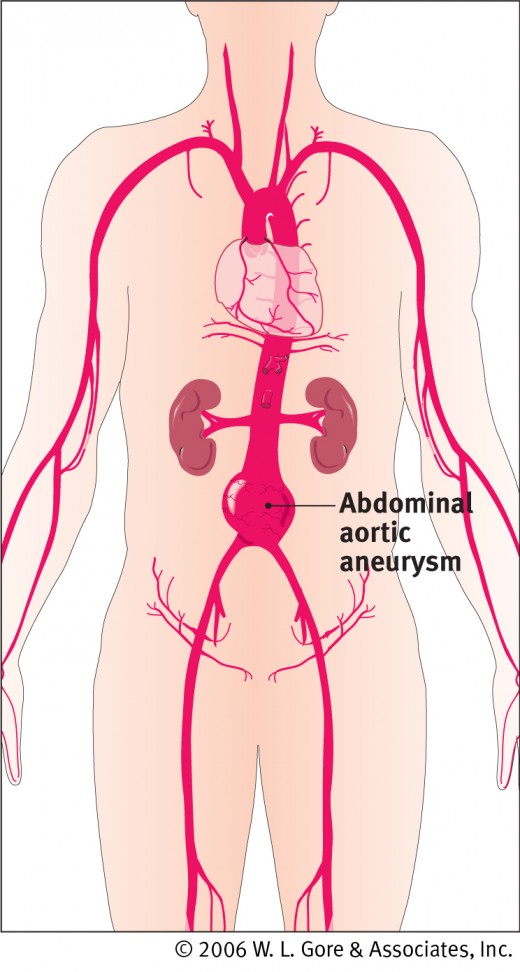 Typical abdominal aortic aneurysm, aorta, heart, kidneys, and other major blood vessels