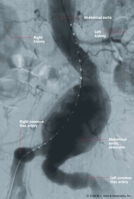 Fluoroscopic view of an abdominal aortic aneurysm, kidneys, and other major blood vessels