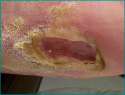 Typical Diabetic Foot Ulcer