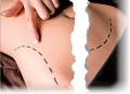 Tips About a Mini Tummy Tuck