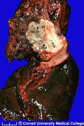 Lung diseased from smoking.