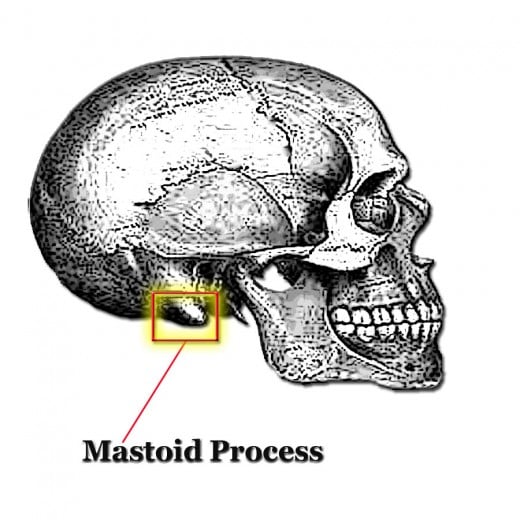 A BAHA hearing aid has a titanium screw implanted into the mastoid process. It transmits vibrations through the skull bone directly to the cochlea.