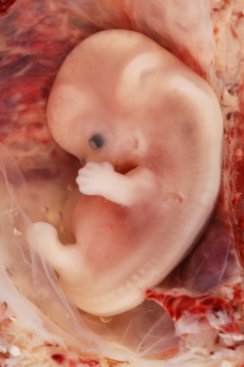 'Licensed under the Creative Commons Attribution-Share Alike 2.0 Generic license'. See: http://en.wikipedia.org/wiki/File:9-Week_Human_Embryo_from_Ectopic_Pregnancy.jpg