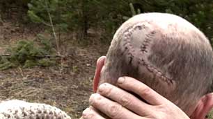 Scars from a bear attack.