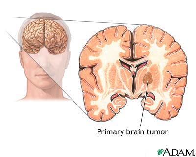 brain tumor at the early stages