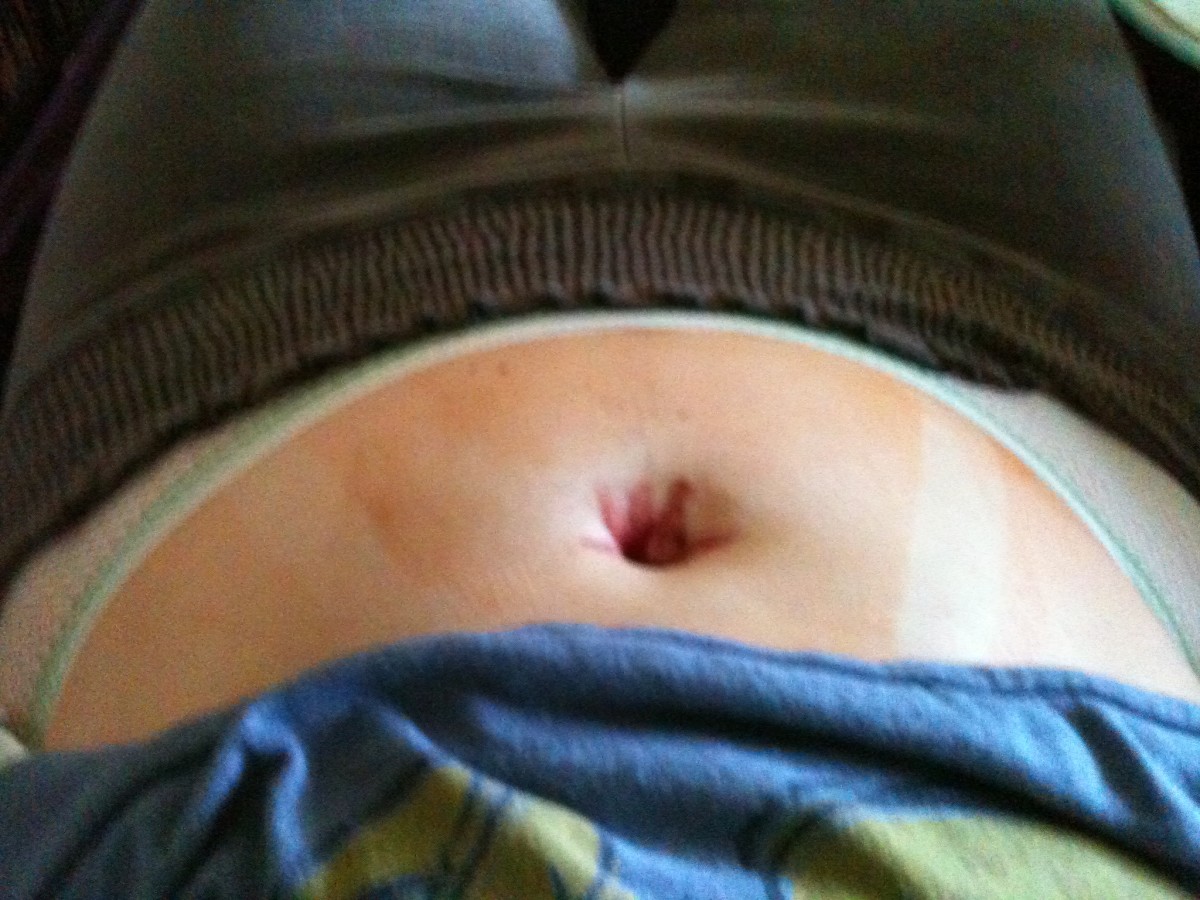 belly button incision and steri strips