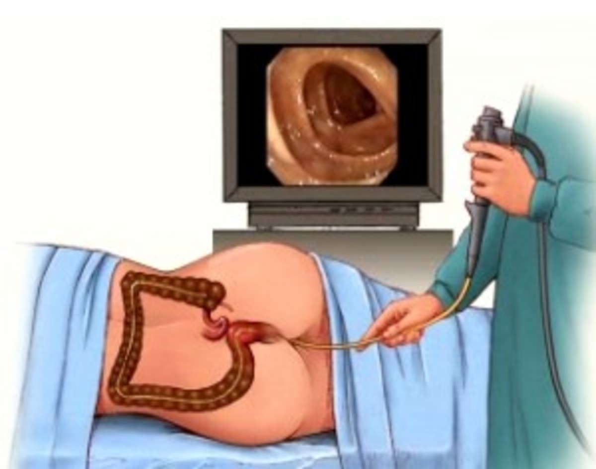 colonoscopy procedure