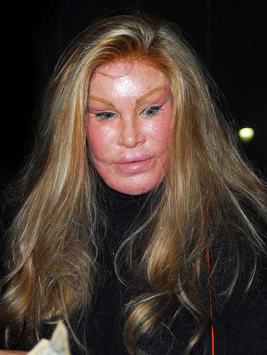 A few steps too far!  She started Cosmetic Surgery to keep her straying husband but he left her anyway.