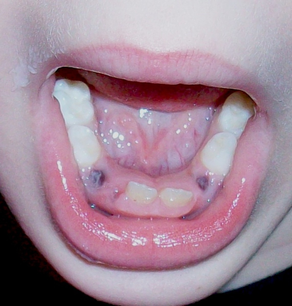 What to Do When Your Young Child Needs Teeth Pulled