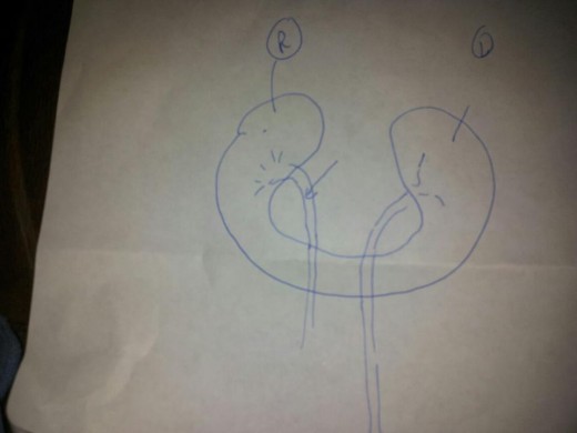 This is a drawing of my horseshoe kidney and the ureters with an arrow pointing out where the blockage is...