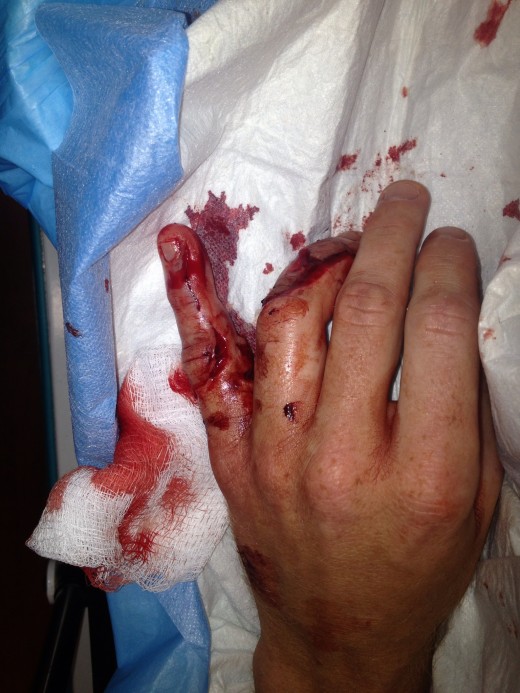 shark bite damage to hand of  surfer Justin Ellingham