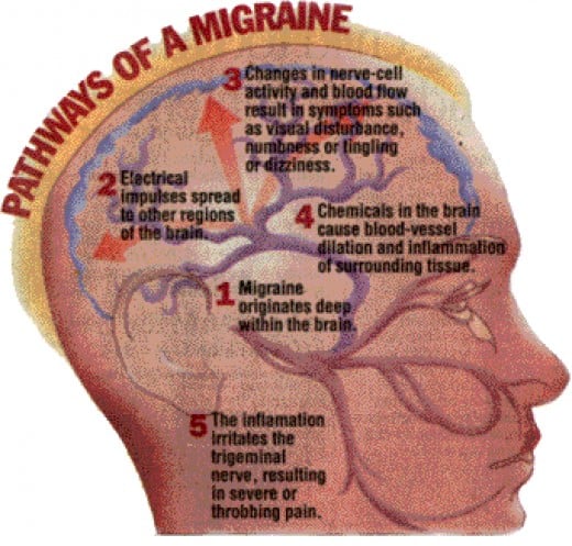 Prescription Migraine Medicine List! HubPages