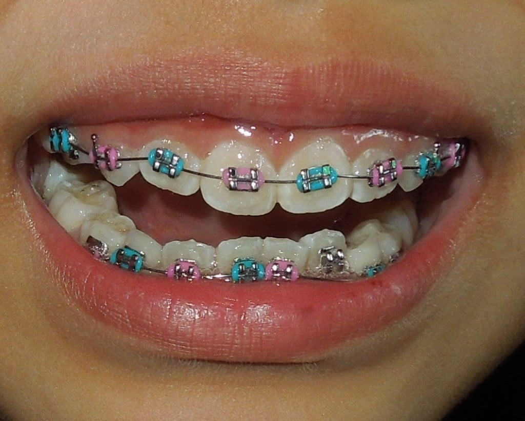 Braces For Kids: How Orthodontics Work | HubPages