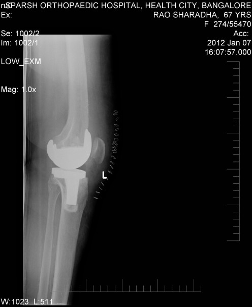 SIDE VIEW OF NEW METAL KNEE JOINT.