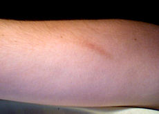 scar tissue