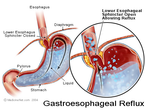 http://www.medicinenet.com/gastroesophageal_reflux_disease_gerd/article.htm
