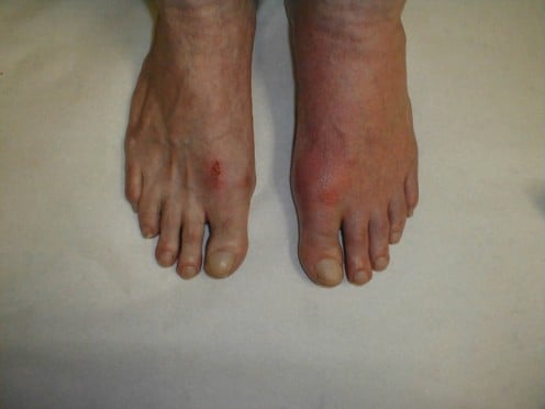 This is what gout looks like on the feet.
