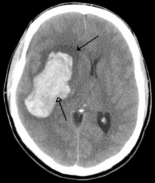 A stroke victim showing a bleed with surrounding damage