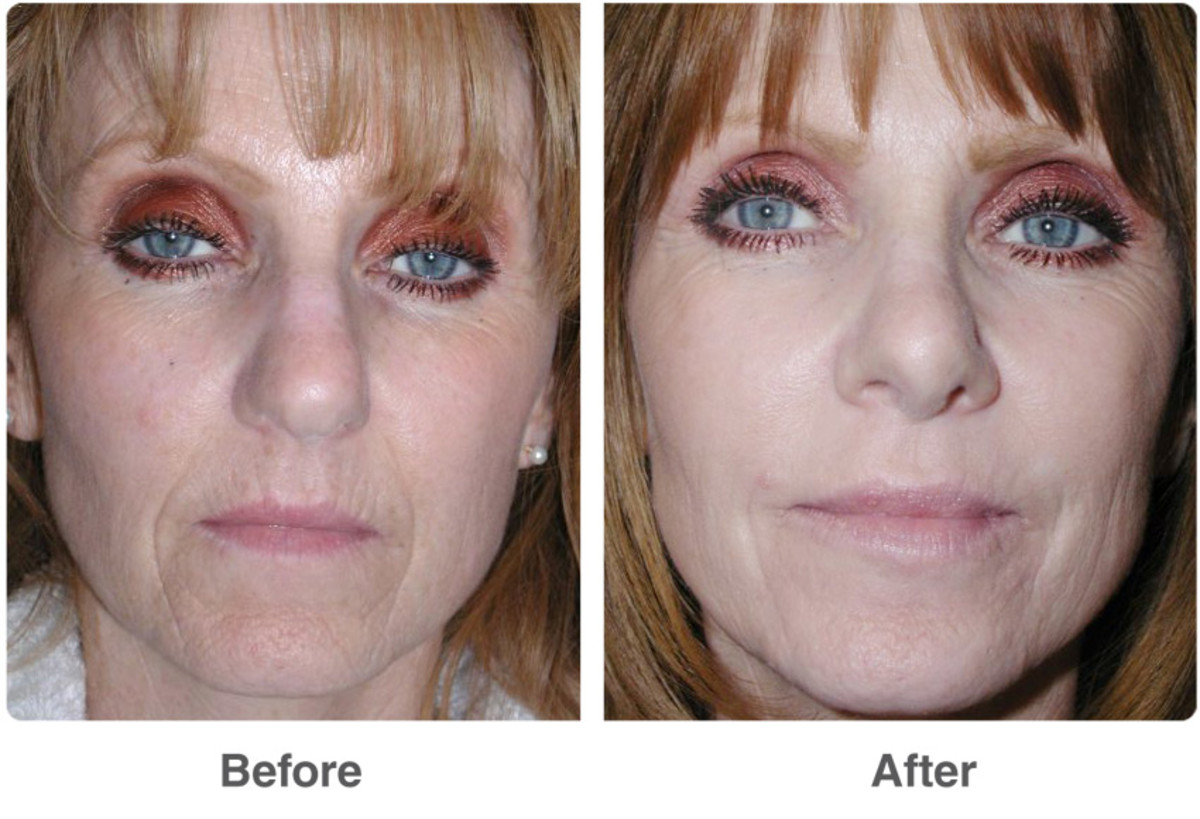 Chemical Peel Before and After Benefits of Acid Peel  HubPages