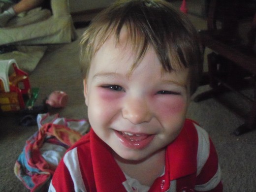 My son with one bite on his left eye. The infection spread to the right side of his face. Both Eyes were closed up the following day. 