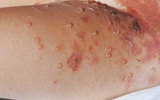 Impetigo CC-BY, Via Wikimedia Commons