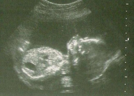baby scan