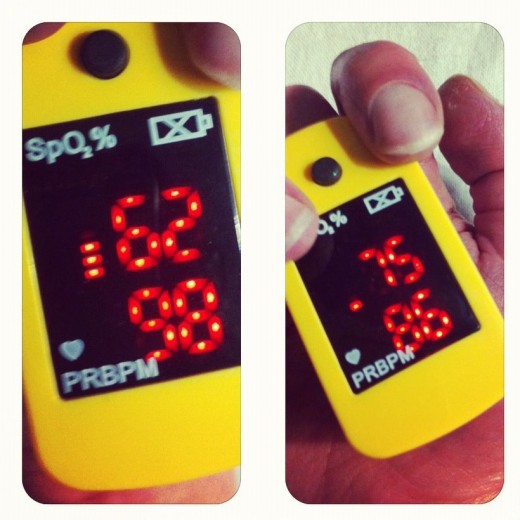 Pulse Oximeter  of a Cyanotic Congenital Heart Patient with Hypoplastic Right Heart Syndrome 