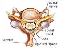 Spinal cord compression steroid dose