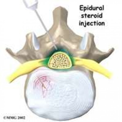 Injections for back pain and neck pain: Indications and Expectations ...