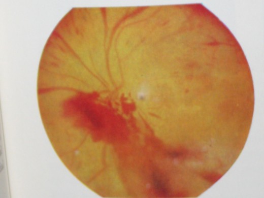 Diabetic Retinopathy showing Retinal Haemorrhages which can lead to blindness