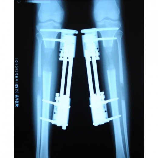Does leg lengthening surgery hurt..?