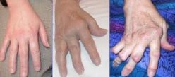 Conventional Rheumatoid Arthritis Treatments