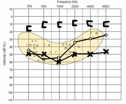 A typical audiogram for conductive hearing loss. The "x" & "o" show the hearing for the left and right ears when sound is presented through earphones. When the middle ear is bypassed, however, the hearing level demonstrates normal levels (brackets).