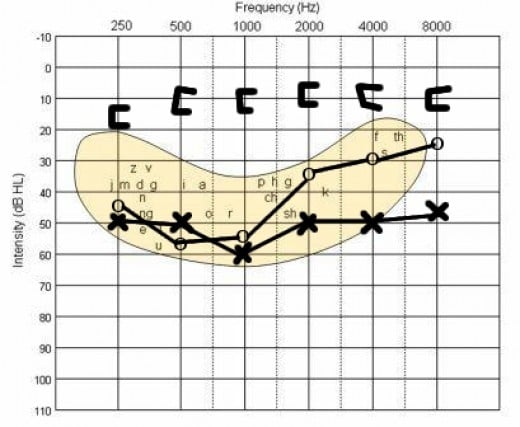 Conductive Hearing Loss Causes And Treatment | HubPages