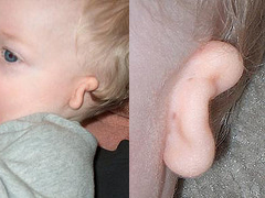 Microtia and Atresia has many different levels of severity. Surgery or bone anchored hearing aids are required to restore access to sound.