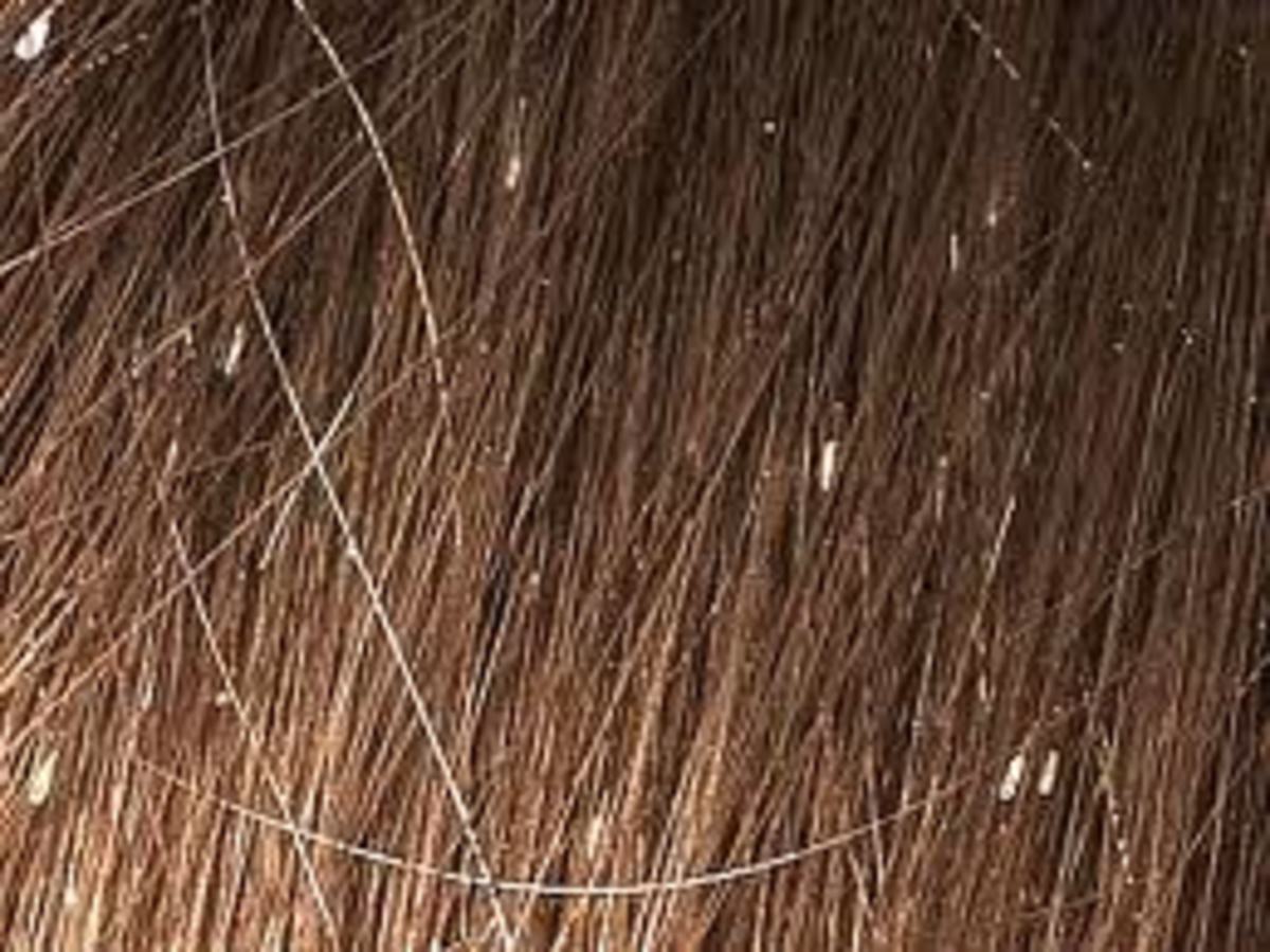 Can Cutting Your Hair Get Rid Of Lice - slidawgdesigns