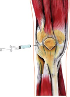 Knee joint injection is given just below the kneecap or patella by a physician 