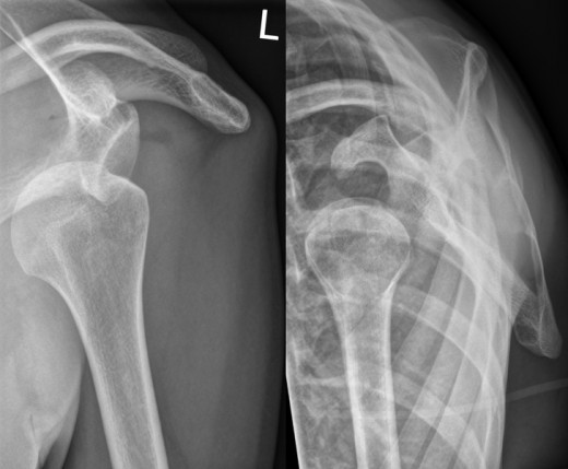 X-ray of a severely dislocated shoulder.