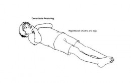 Neurologic And Sensory Disorders Nurse Key Decorticate Posture Is More Common In Case Of Reye 39 S Syndrome And Head Injury It An Unreliable Sign Infants Age Less Than 2 Years Old Due To