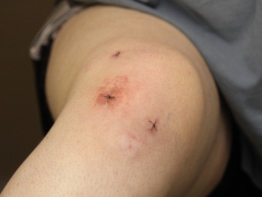 Cameras and other instruments are passed through small incisions into the joint.