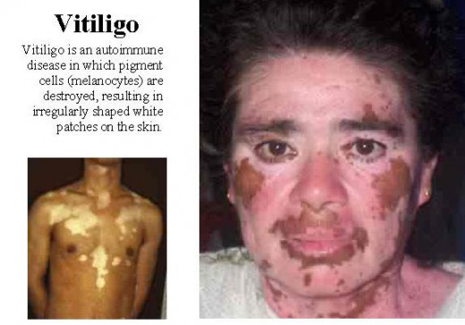 Disease that causes facial skin to turn white