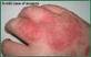 Eczema on Hand
