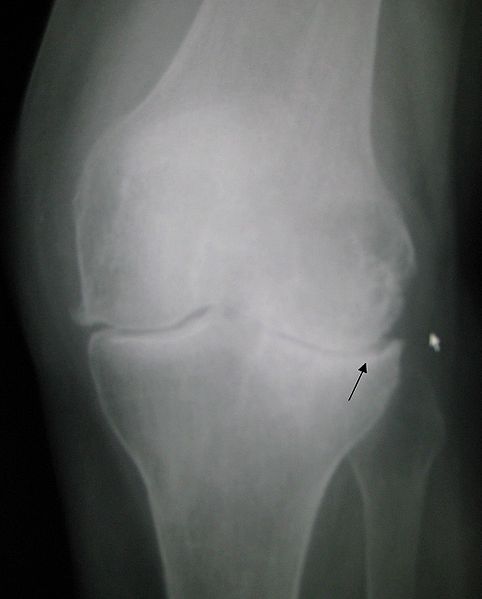 Arthritis of the left Knee